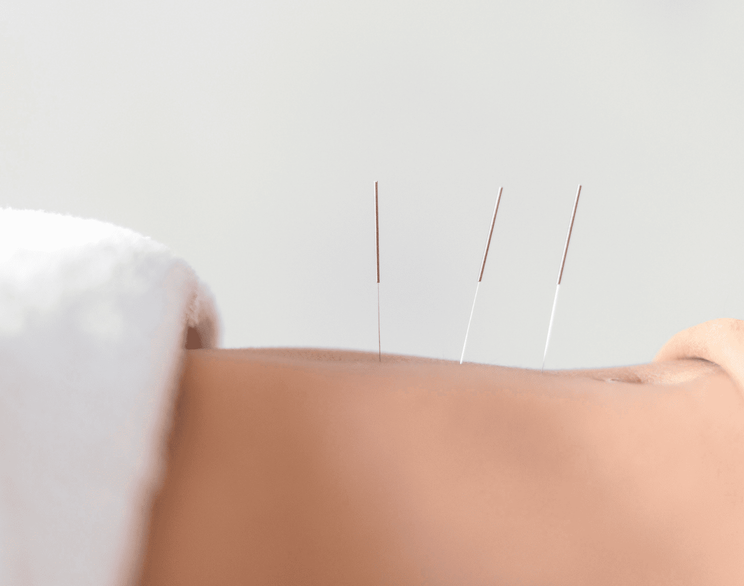 Woman receiving acupuncture therapy