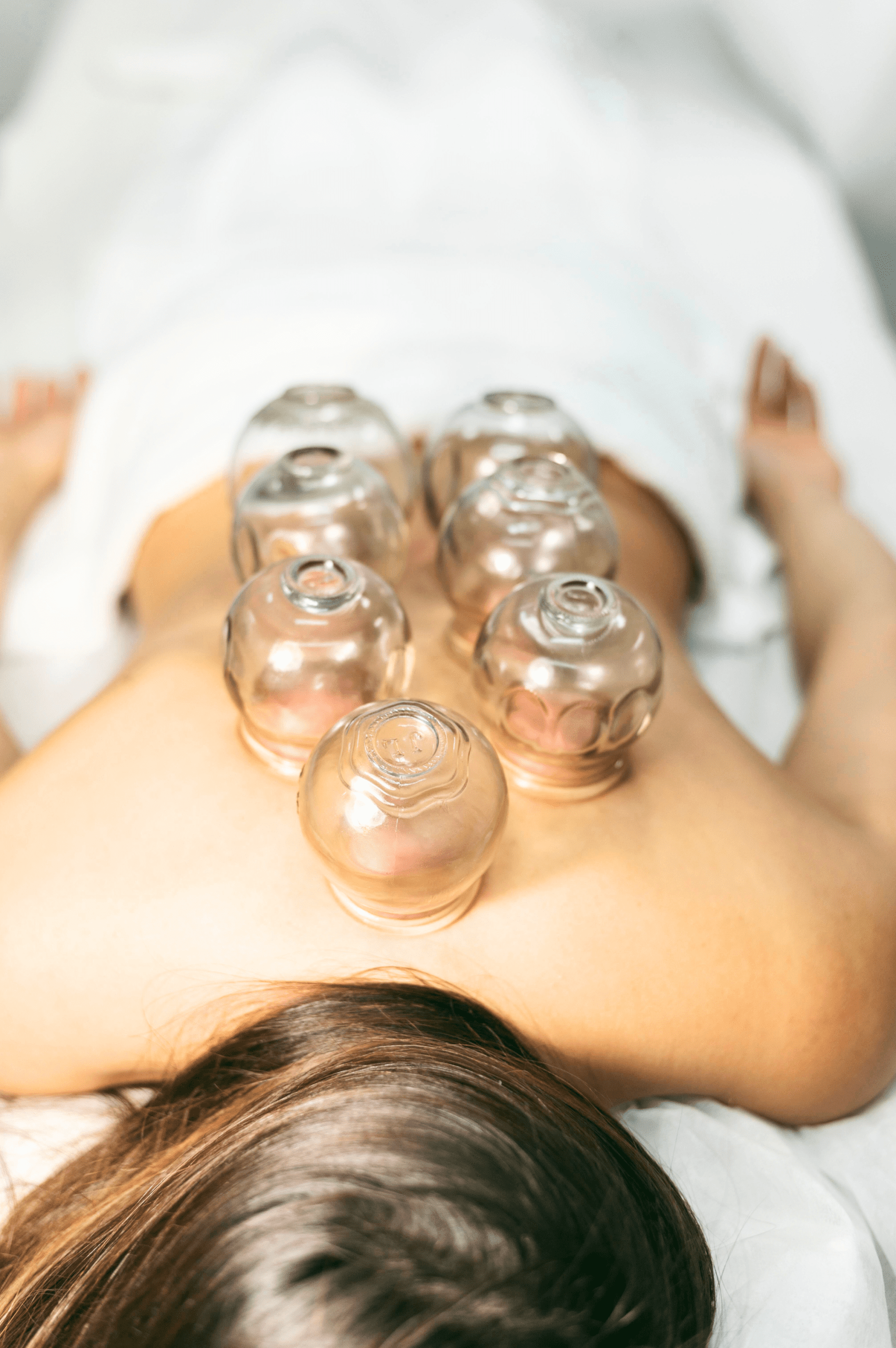 Woman receiving acupuncture therapy